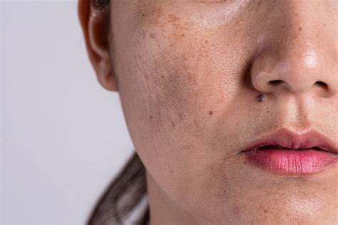 Brown Spots On Your Skin