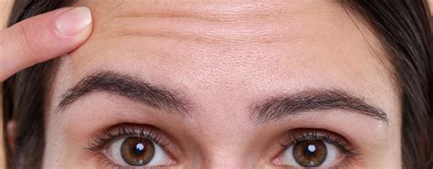 How to Reduce Forehead Lines & Wrinkles Without Injectables