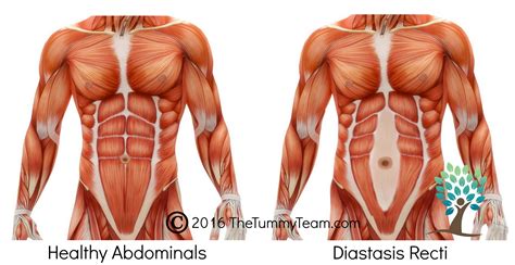 Diastasis Recti | The Tummy Team