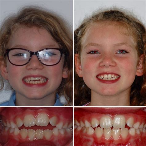 End crooked thumb sucking teeth - Stop Thumb Sucking