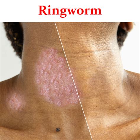 Ringworms- Product Box – Sharma Pharmacy