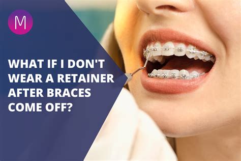 Orthodontic Retainer Top Teeth Retainer In Dubai | Al Hana Modern