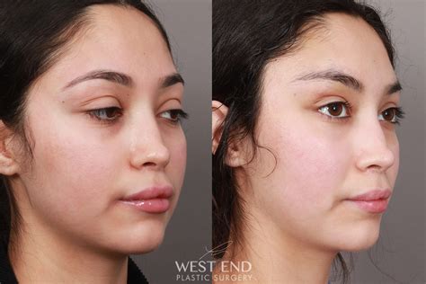 Staples In Scalp After Brow Lift at Zoe Szabados blog