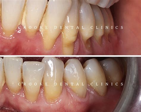 How Much Does A Gingival Graft Cost at Mike Fahey blog