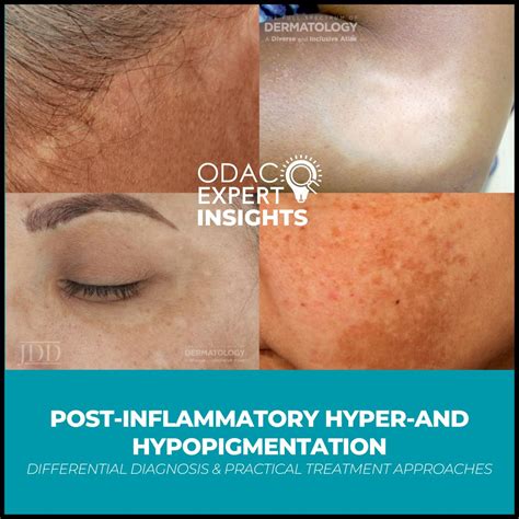 Post-Inflammatory Hyper-and Hypopigmentation: Differential Diagnosis & Practical Treatment ...