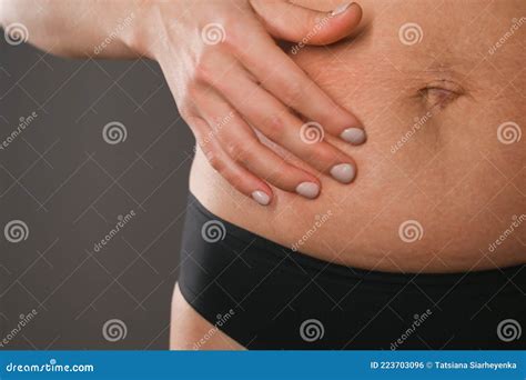 Close-up of Female Hand Showing Stretch Marks. Women Body after ...