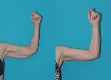 Arm Lift After Care at Katie Eliott blog