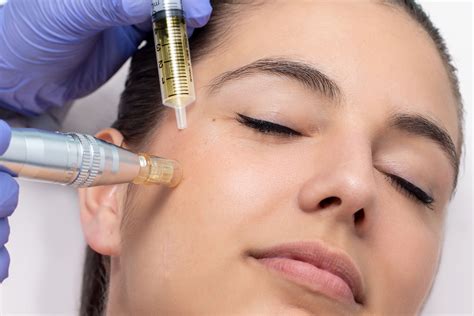 PRP-Platelet Rich Plasma Skin Needling