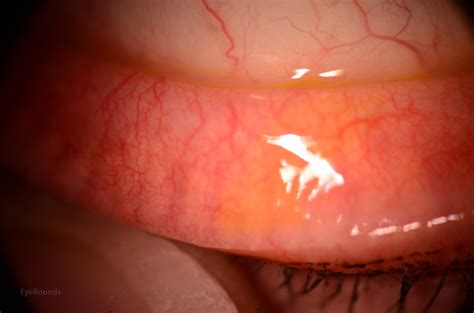 Meibomian Gland Swelling
