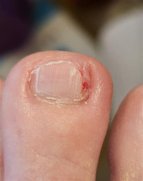 About twice a year I have to do a little DIY ingrown nail removal on this one toe. Most painful ...