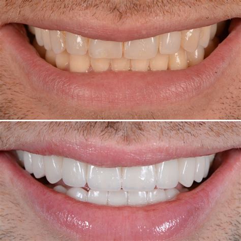 Composite Veneers Pros And Cons