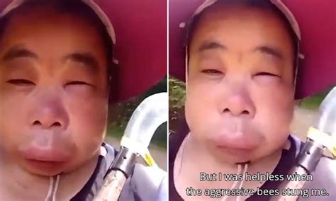 Bee Sting Face Swelling