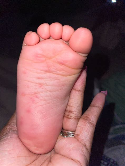 Raised Bumps On Bottom Of Foot Online | emergencydentistry.com