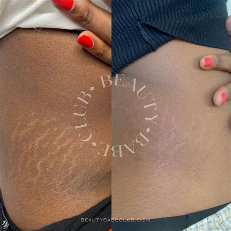 Tattoo stretch marks before and after - Bronctattooaus.com