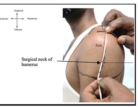 Figure 13 - Deltoid Intramuscular Injections: A Systematic