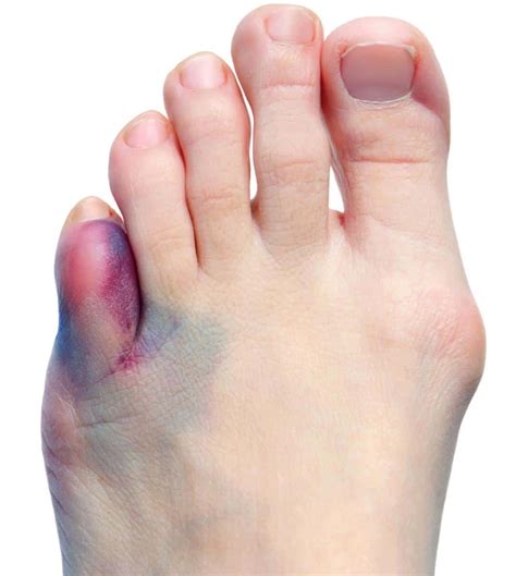 Broken Big Toe BEST Treatment [Signs, Symptoms, TAPING & Air CAST]