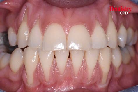 Types Of Gingival Recession at Lachlan Ricardo blog