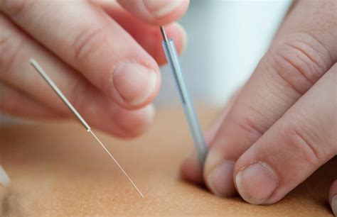 How Dry Needling Can Treat Pelvic Floor Conditions | Acupuncturist St ...