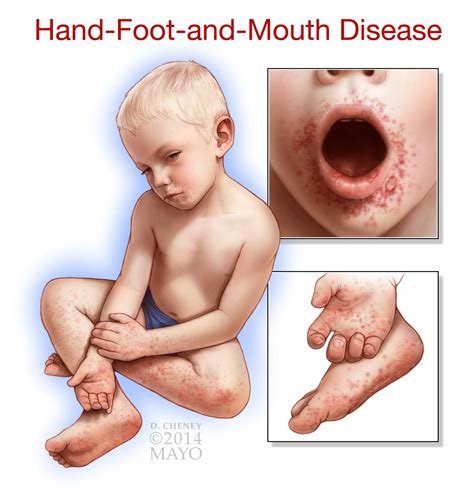 How To Treat Hand Foot And Mouth Disease In Toddlers - Templates Sample ...