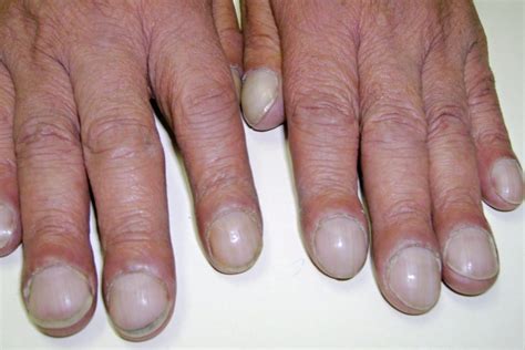 Clubbed Fingers and Nails: Causes and What They Look Like