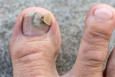 Nail Avulsion | The Foot Practice Podiatry Singapore