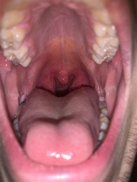 Normal Tonsils Open Mouth Normal And Tonsillitis Bacterial And Viral