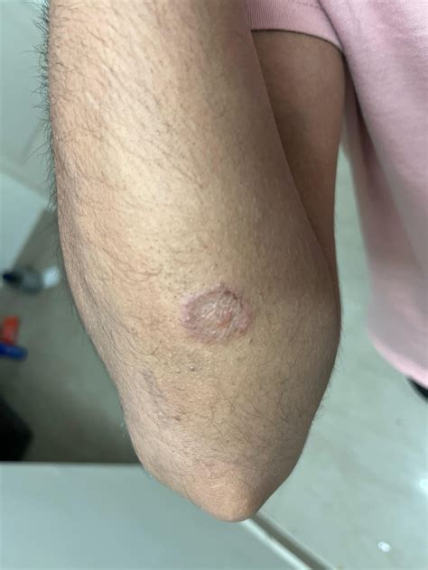 What is this? I've had this on my elbow for a few weeks now, the ...