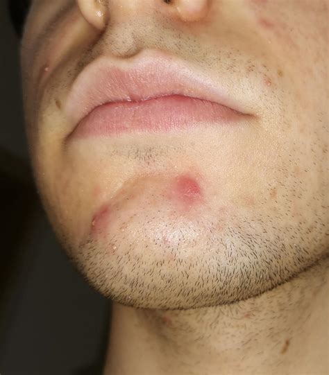 Under The Skin Chin Pimple