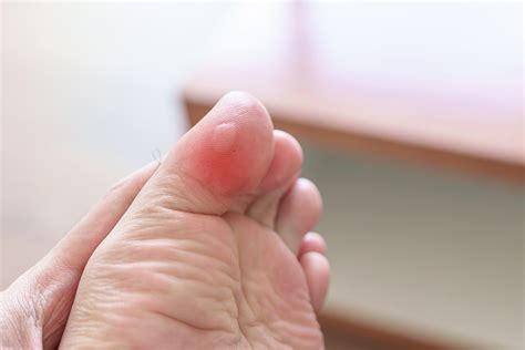 Ampollas en los pies: por qué salen, cuándo se pueden reventar y cómo curarlas