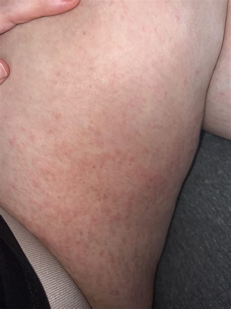 Itchy inner thighs : r/medical