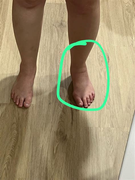 Swelling in foot/ankle : r/hysterectomy