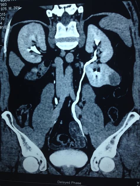 VIETNAMESE MEDIC ULTRASOUND: CASE 457: AML KIDNEY TUMOR, Dr PHAN THANH HẢI, Dr NGUYỄN HOÀNG ĐỨC ...