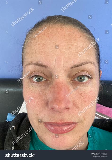 Addison's Disease Face