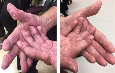 Finger nodules: Tip of the gouty iceberg | Cleveland Clinic Journal of ...