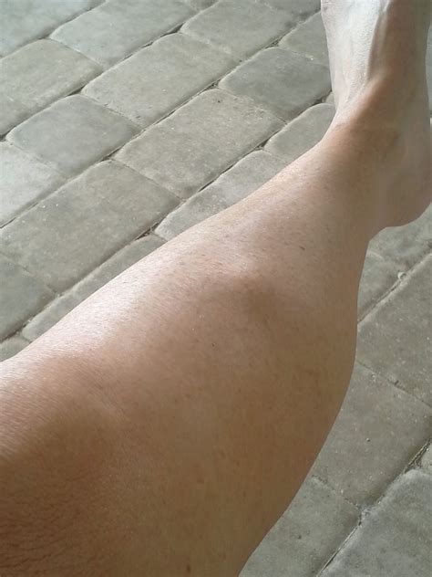 Painful Lump On Bone In Hand at Megan Blackmon blog