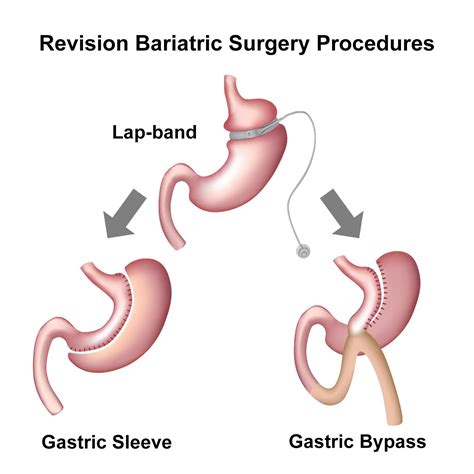 Gastric Bypass Revision - Long Beach, CA - Los Angeles, CA