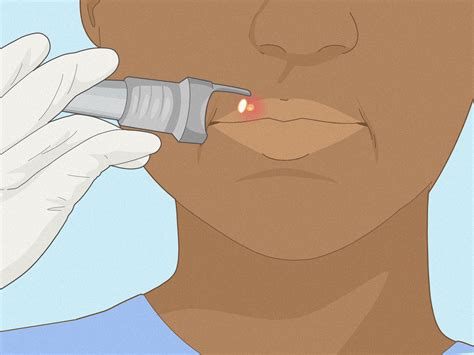 How To Pop A Painful Pimple On My Lip - Infoupdate.org
