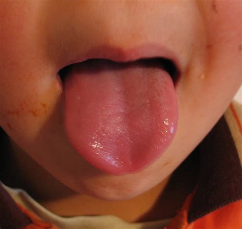 Normal Healthy Tongue Color