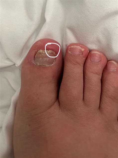 I am back 7 months after a total nail avulsion, my toenails are growing but this one is growing ...