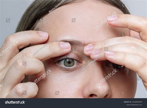 Milia Milium On Eyelid Young Woman Stock Photo 2516032397 | Shutterstock