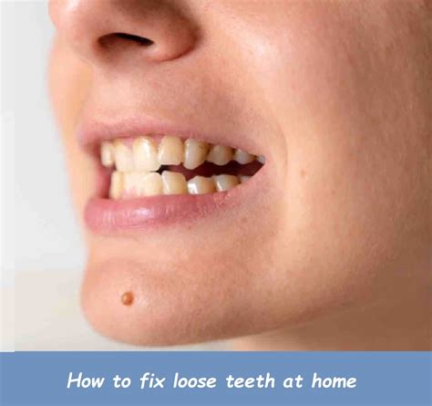 How to fix loose teeth at home