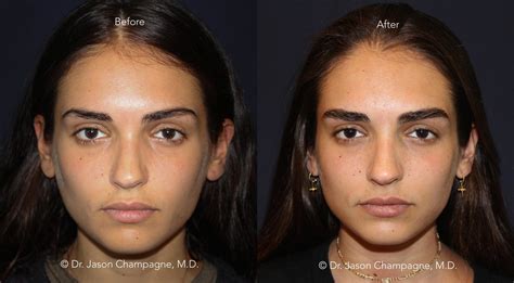 Eyebrow Hair Transplantation Gallery | Beverly Hills Plastic Surgeon - Dr. Jason Champagne
