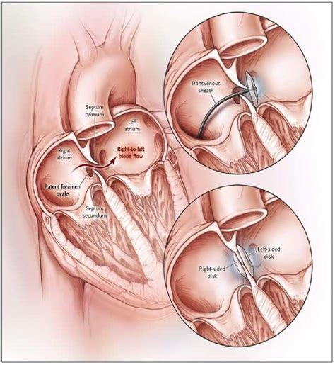 Figure 1 from Patent Foramen Ovale and Atrial Septal Aneurysm in Young ...