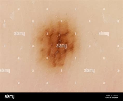 Dermatoscope image of a mole on the sole of the foot of a 35 year old Hispanic female patient ...