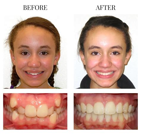Palate Expander Before And After