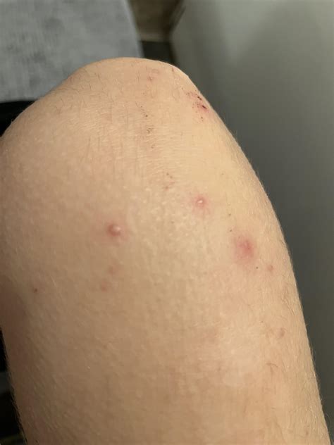 Eczema Bumps On Legs Rash On Inner Thigh: 12 Causes And Treatments For