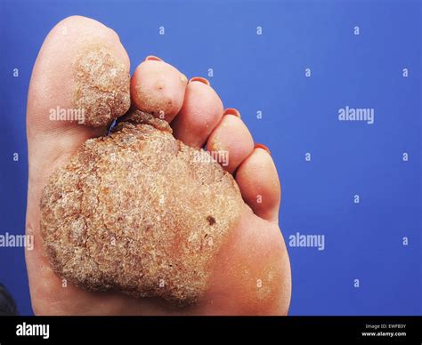 Plantar Wart