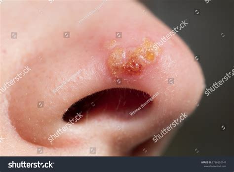 Herpes Simplex Under Nose at Rachel Vance blog
