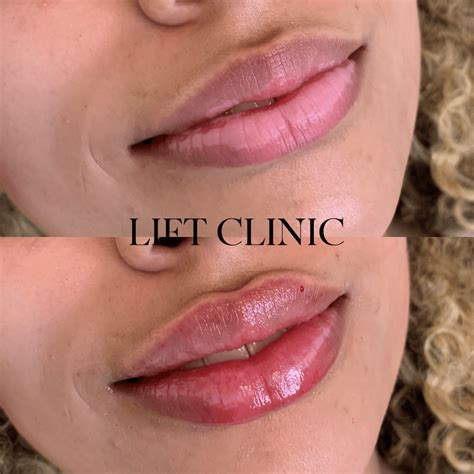 What Does 1ml of Lip Filler Look Like? 1ml Lip Fillers Before and After ...