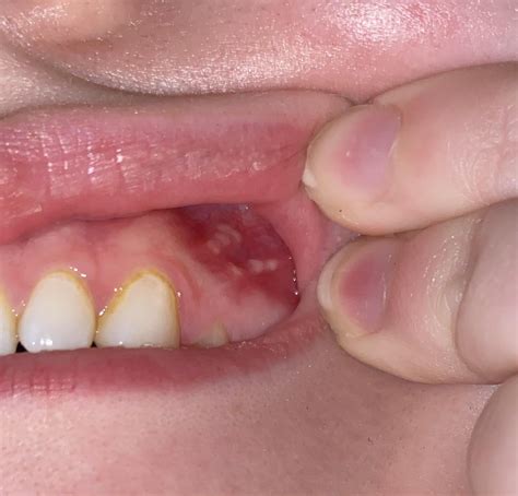 Bumps on my gums? : r/medical_advice